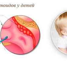 Adenoidi pri otrocih: simptomi in zdravljenje