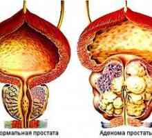 Adenoma prostate: zdravljenje z ljudskimi zdravili