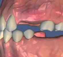 Adentia zob: vzroki, simptomi, zdravljenje pri otroku