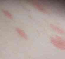 Alergije na kožo, rdeče točke so srbenje: zdravljenje