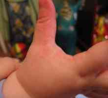 Alergije na prste otroka in na rokah