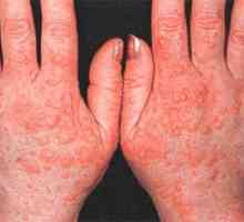 Alergije na rokah in prstih s fotografijo
