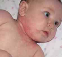 Alergije pri novorojenčkih in dojenčkih