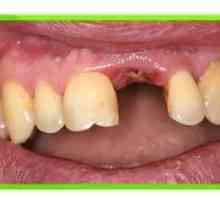 Alveolitis po zdravljenju z zdravljenjem zob in preprečevanjem