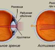 Astigmatizem očesa: kaj je to, fotografija, zdravljenje pri odraslih