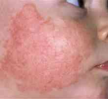 Atipični dermatitis: njegove vrste in metode zdravljenja
