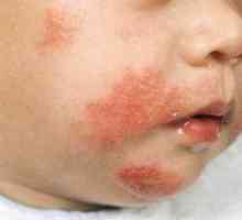 Atopični dermatitis pri otrocih: fotografije simptomov in zdravljenja