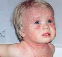 Atopični dermatitis pri dojenčku s fotografijo