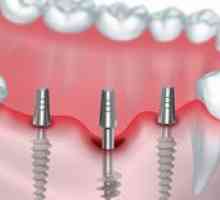Basalna implantacija: prednosti bazalne implantacije zob