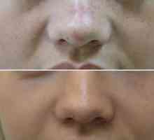 Nekirurška rinoplastika nosu s polnili in nitmi