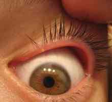Blefaritis očesa: kaj je to, simptomi, zdravljenje