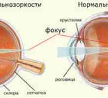 Myopia, hiperopija. Zakaj se žarki ne osredotočajo na mrežnico?