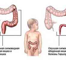 Hirschsprungova bolezen pri otrocih simptome