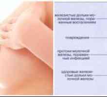 Prsni koš med dojenjem: vzroki, simptomi in zdravljenje