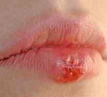 Razjede na ustnicah: razne rane, vzroki, simptomi
