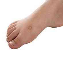 Bradavice na nogah: foto formacije na stopalih in njihovo zdravljenje