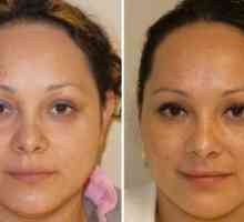 Botox za obraz: kontraindikacije pred in po