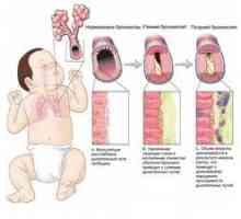 Bronhitis pri otrocih: mnenje Komarovskega in posebno zdravljenje