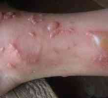 Bilozni dermatitis: simptomi, zdravljenje in preprečevanje