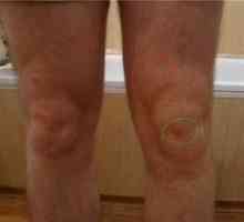 Burzitis kolena: simptomi in zdravljenje