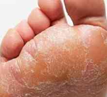 Preden se zdravimo z glivicami stopal: pripravki kemikalije in nacionalni agenti