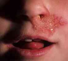 Bolje je razmazati rane v nosu: razloge za njihovo nastanek in zdravljenje