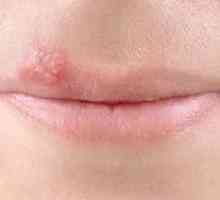 Torej je herpes na ustnici v nosečnosti nevaren