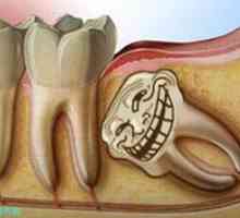 Kaj storiti, če zobje modrosti raste in dlesni boli