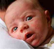 Kaj storiti, če ima novorojenček izpuščaj na obrazu