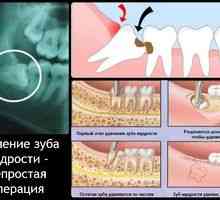 Kaj storiti po ekstrakciji zob: potrebna priporočila
