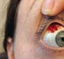 Kaj storiti, če je krvavitev oči: simptomi in zdravljenje