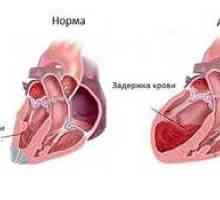 Kaj je to - astma srca, simptomi in zdravljenje