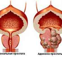Kaj je prostate? Simptomi in zdravljenje?