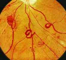 Kaj je diabetična retinopatija: faze, simptomi in zdravljenje