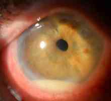Kaj je to bolezen očesne bolezni iridociklitis?