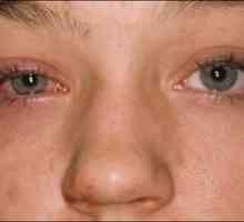Kaj je to - keratitis očesa: simptomi, fotografije in zdravljenje