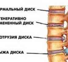 Kaj je to - štrlenje hrbtenice in kako ga zdraviti