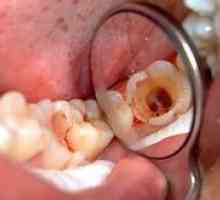 Kaj je pulpitis: simptomi in zobozdravstveno zdravljenje?