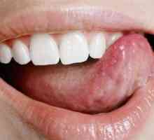 Kaj so bolečine v ustih?