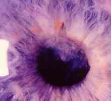 Kaj je apahakija, značilnosti te patologije oči
