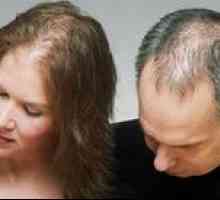 Kaj je Androgenska alopecija pri ženskah in moških?