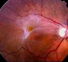 Kaj je epiretinalna fibroza oči?