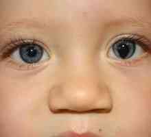 Kakšna je koloboma očesa irisa in veke?