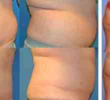 Kaj je liposukcija: vrste, pluse in minusi postopka