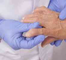 Kakšna bolezen artritis in kako ga zdraviti