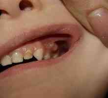 Gumija na dlesni pri otroku: simptomi in zdravljenje