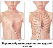 Deformacija prsnega koša pri otroku