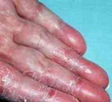 Dermatitis na rokah: zdravljenje in fotografije