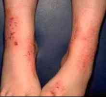 Otroški dermatitis na stopalih: fotografije, vrste in načini zdravljenja