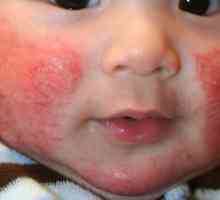 Diateza na obrazih otroškega zdravljenja